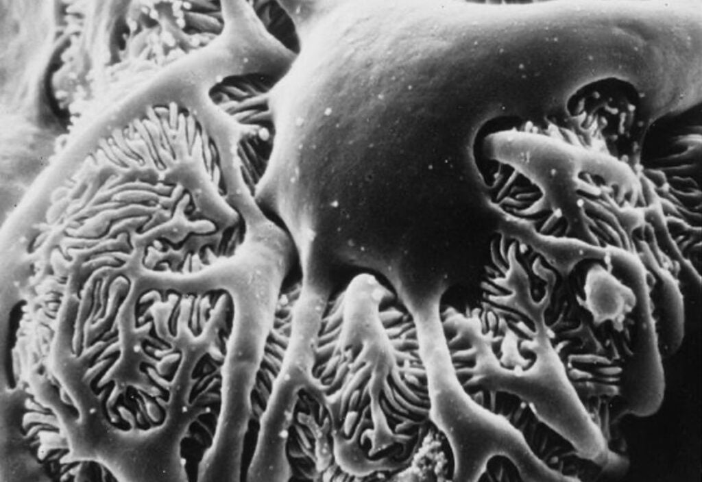 Nephrotic Syndrome