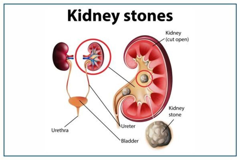 You are currently viewing Kidney Stone Disease